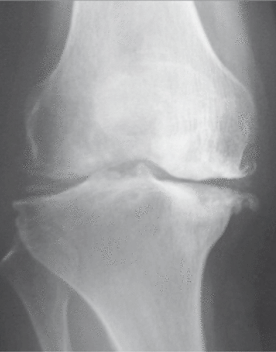Figure 2. Osteoarthritis of the knee. The knee joint is the most common site of osteoarthritis. The anteroposterior radiograph reveals the valgus deformity of the joint, joint space narrowing, osteophyte formation and sclerosis of subchondral bone. In knee osteoarthritis, medial femorotibial alterations often predominate.