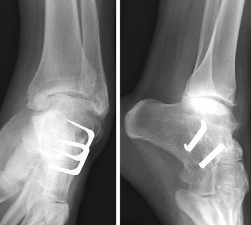 Figure 1. Extensive osteoarthritis of the ankle joint after a subtalar fusion had been performed. Note the pes equinovarus adductus deformation.
