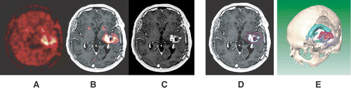 Figure 1. A 41-year-old male patient (No. 7) suffering from recurrent glioblastoma in the left temporal lobe. The FET-PET scan (A) shows a larger tumour extension than the corresponding Gd-enhanced MR scan (C); see also the fused image (B). The discrepancies between tumour borders, defined on the PET and MR scans, are shown in the transversal MR image (D) and in the 3D surface-based reconstruction (E). The blue-coloured line/surface marks the MRI-based tumour borders and the rose-coloured line/surface marks the PET-based tumour borders. The green-coloured surface in the image E marks the ventricular system.