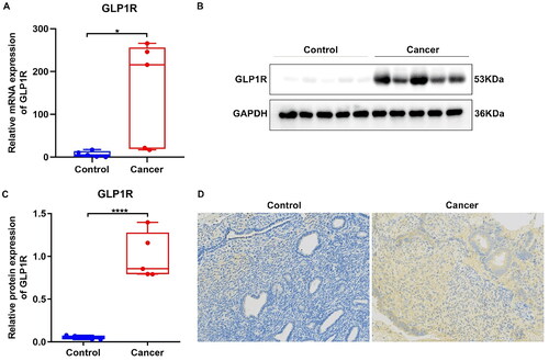 Figure 2. Up-regulation of GLP1R in EC tissue specimens. (A) RT-qPCR for GLP1R mRNA expression between tumour and normal samples. (B,C) Western blotting for GLP1R protein between tumour and normal samples. (D) Immunohistochemistry of GLP1R protein in tumour and normal samples. Positive cells are stained by DAB and appear as brown, and cell nucleus is stained by haematoxylin as blue. *p < 0.05 and ****p < 0.0001.