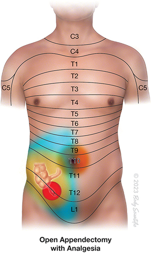 Figure 4 Anesthetic coverage by a well performed Quadratus Lumborum block providing adequate coverage of the pain of open appendectomy (blue overlay). However, some amount of visceral pain is not completely blocked. ©2023 Body Scientific International, LLC.
