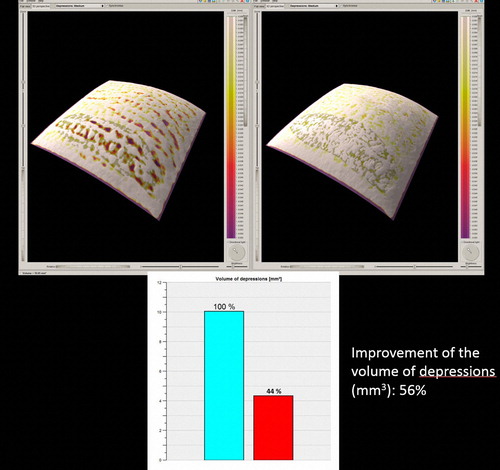 Figure 4. The 3D skin surface analysis of the 28 year-old, ST III female depicted in Figure 3, before the treatment (left), and 3 months after the end of treatment (right).