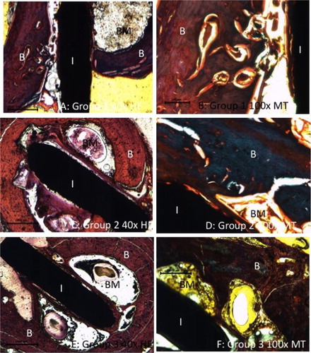 Figure 5. Micrographs of the non-decalcified sections show bone marrow depletion and replacement by fibrous and/or bone tissue adjacent to the implant. The implant exhibits osseointegration at several contact points. I: implant; B: bone; BM: bone marrow; H&E: hematoxylin-eosin; MT: Masson's trichrome.