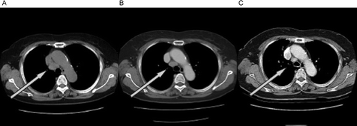 Figure 1.  Chest computed tomography scan (A) before treatment of gefitinib, (B) 2 months after treatment and (C) 14 months after treatment. The arrows show the mediasitinal lymphnode metastasis that gradually regressed in size.