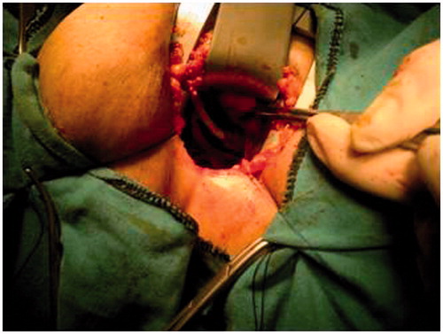 Figure 1. Operation image of our one patient.