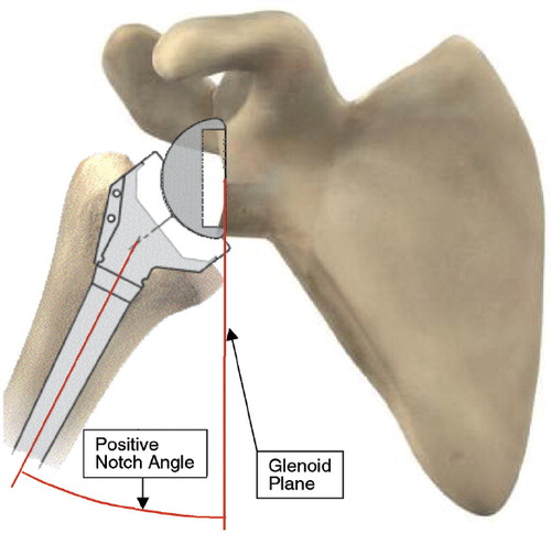 Figure 1. Delta CTA prosthesis build in the average anatomical model based on 200 measured scapulae, with specific interest in the shape of the glenoid cavity, the infraglenoid tubercle, and the lateral border of the scapula. The prosthesis has a flat baseplate situated as distally as possible to ensure full bony coverage of this baseplate with the inferior screw surrounded by minimum 2 mm bone, and a glenosphere 36 mm with a standard polyethylene cup. The notch angand le is the maximum adduction angle before a conflict arises between the PE cup and scapular pillar.