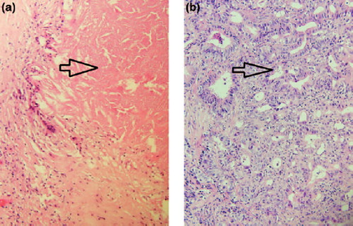Figure 2. (a). Tumour biopsy pre-conversion therapy. (40×). Invasive adenocarcinoma is arrowed. (b). Lymph node from resection specimen post-conversion therapy. Extensive treatment effect including fibrosis has obliterated normal lymph node architecture. Necrosis (arrowed) is present, consistent with treated tumour and is associated with palisaded giant cell reaction. (40×).