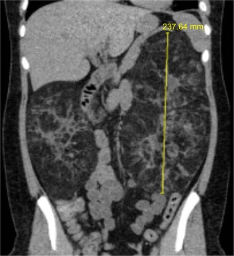 Figure 2 Renal computed tomography scan demonstrating significant angiomyolipomata burden in both kidneys of a patient with tuberous sclerosis complex.