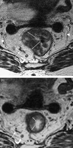 Figure 1.  T2 weighted MRI images obtained perpendicular to the long axis of the rectal tumour (a) before and (b) after short course radiotherapy showing reduction in tumour width post radiotherapy. In this case, tumour width reduced by 52% following short course radiotherapy. The images are obtained are at exactly matched levels as shown by the position of an adjacent lymph node (curved arrow) and vessels (arrow). The markers show how multiple radial measurements of tumour thickness were obtained to calculate the overall width measurement as a sum of the longest diameters (sum LD) according to RECIST criteria. The position of the mesorectal fascia is shown (arrow heads).