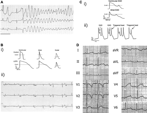 Figure 1. Mechanisms of arrhythmogenesis in long QT syndrome. A: ECG of patient with LQTS degenerating into torsades de pointes (TdP) and showing classical undulating baseline. B: (i) APDs in control and LQTS human induced pluripotent stem cell-derived cardiomyocytes (iPSC-CMs) showing significant prolongation. (ii) ECG in patient with LQTS demonstrating significant increase in QT duration. C: (i) Early after-depolarizations (EADs) in stem cell-derived ventricular and atrial cells. (ii) EADs resulting in triggered activity in iPSC-CMs. D: 12-lead ECG from a patient with LQT2 showing profoundly bifid T waves. Reproduced with permission from (A, B(ii)) Salama and London, J Physiol 2007;578:43–53 (Citation26); (B(i), C) Itzhaki et al., Nature 2011;471(7337): 225–9 (Citation19); (D) Zhang et al., Circulation 2000;102(23):2849–55 (Citation140).