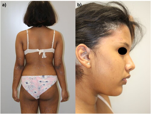 Figure 1. Several erythematous-desquamative patches and plaques spread at the back, lower limbs (a) and scalp (b) of a 17-year-old girl.