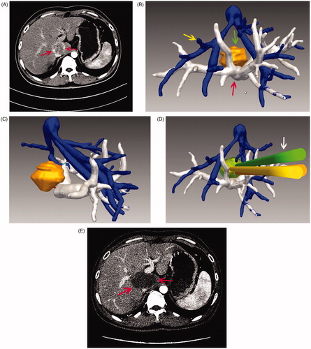 Figure 3. Images in a 45-year-old patient with a tumour in the caudate lobe. (A) Preoperative CT imaging showed that the tumour was close to the portal vein. (B) The 3D visualisation images visualised the spatial relationship of tumour and the surrounding pipe in multi-angle. (C) The 3D visualisation images visualised the shortest distance between the tumour and surrounding vessels. (D) The preoperative planning was achieved through 3D visualisation of preoperative planning system, and three needles were needed to ablate the tumour completely. (E) The contrast-enhanced CT showed complete tumour necrosis a month after microwave ablation.