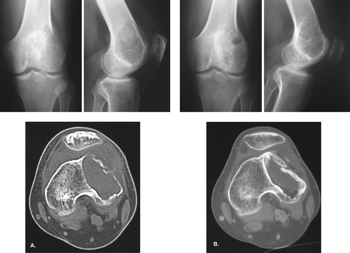 Figure 1. A 34-year-old male with a giant cell tumor in the left femur. A. Computed tomography showed a thin wall around the cavity 1 month after the curettage. B. 1 year postoperatively, bone formation was excellent and the cortex of the cavity was thicker than the normal cortex of the medial condyle.