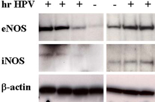 Figure 1. A representative illustration of eNOS and iNOS protein expression (Western blotting) in cervical samples from women with (+) and without (–) hrHPV. Tissue homogenates (containing 25 µg of total protein) were loaded, separated by gel electrophoresis, and immunoblotted with specific monoclonal antibodies to eNOS and iNOS. Signal intensity was quantified by densitometry and normalized to that of β-actin (loading control).