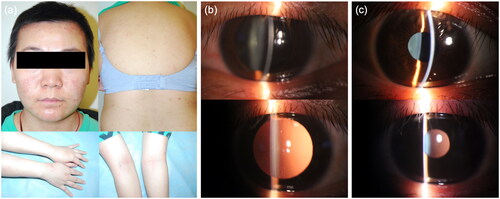 Figure 1. (a) Erythemas and red papules could be seen on the cheeks, Chin, trunk and extremities including flexural distribution. The skin on the entire body was dry. (b) Signs on slit-lamp examination when the patient had ophthalmologic symptoms were consistent with uveitis. (c) No evident signs were found on slit-lamp examination after management.