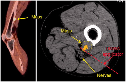 Figure 6. Sagittal fused PET/CT image (left) and axial non-contrast CT image (right) of melanoma metastasis to left femur abutting tibial and peroneal nerves. Illustration of hypothetical DMWA applicator placement (red dotted line) and direction of microwave emission (orange arrow) to treat the tumor and avoid injury to the neurovascular bundle.