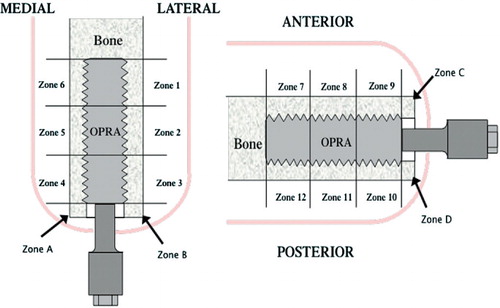 Figure 5. The bone surrounding the implant is divided into zones 1–6, A, and B for medial and lateral assessment of bone remodeling and zones 7–12, C, and D for anterior and posterior assessment of bone remodeling.
