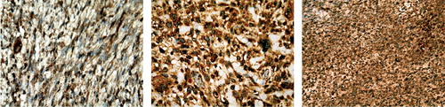 Figure 1. Immunohistochemical analysis of YKL-40 protein expression in paraffin sections of different types of soft-tissue sarcomas. The cytoplasmatic glycoproteins in both the tumor cells and the tumor stroma cells take up the stain, and it is therefore the intensity of all parts of the tumor that is evaluated. Positive immunostaining appears as a cytoplasmic, granular brown-colored staining. Left panel: a peripheral nerve sheet tumor, Trojani grade 2, with an average YKL-40 intensity score of 1. Middle panel: an unclassifiable sarcoma, Trojani grade 3, with an average YKL-40 intensity score of 2. Right panel: a synovial sarcoma, Trojani grade 3, with an average YKL-40 intensity score of 3.