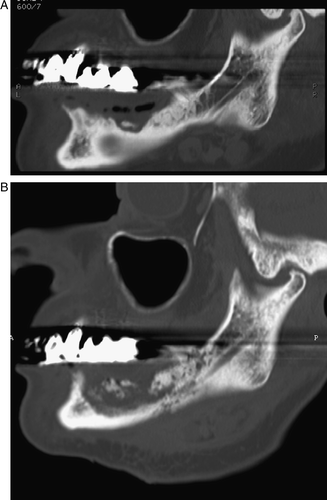 Figure 2.  A. ONJ of the right hemi-mandible. First CT oblique sagittal reconstruction displayed with bone window setting showing an osteolytic lesion with a small sequestrum surrounded by sclerotic bone, B. Second CT examination reconstructed in the same plane showing progressive disease characterized by a large area of destruction with small islands of bone or sequestra.