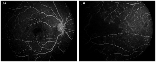 Figure 2. Fluorescein angiography pictures of right eye showing increased foveal avascular zone and multiple areas of patchy capillary dropouts in the periphery and posterior pole.