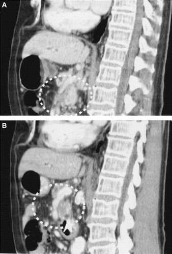 Figure 3.  Shows sagital CT slice depicting the occluded superior mesenteric vein before chemotherapy (A) and improvement in patency after 3 months of treatment (B).