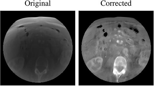 Figure 4. Example a CBCT axial slice before (left) and after (right) cGAN correction. As it can be noticed, the cGAN was effective in the correction of the CBCT. Each image is displayed with Window = 1300, Level = 0.