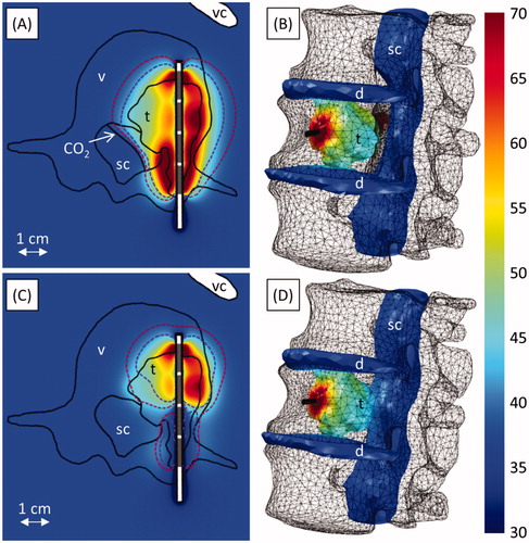 Figure 7. Ablation of a tumour invading the vertebral body and spinal canal at level L2. A-B and C-D respectively show ablation with (Case 4a) and without (Case 4b) carbon dioxide injection for tissue dissection and insulation. Colour maps show temperature (°C) 190 s into the ablation, before power is shut off to any of the transducers. A and C show temperature in an axial slice through the transducers (grey), with the 240 (violet, inner dashed line) and 6 (crimson, outer dashed line) EM43 °C contours 10 min after treatment superimposed. The applicator (black cylinder) and bone surface (black mesh) are shown in B and D. The locations of the tumour (t), vertebrae (v), spinal canal (sc), intervertebral discs (d), vena cava (vc), and carbon dioxide bubble (CO2) are indicated.