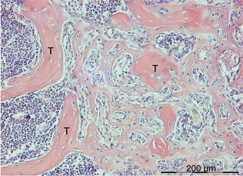 Figure 5. Woven bone formation among old trabeculae (T) in the proximal tibia of a mouse, 1 week after drilling a hole through the marrow. Bone formation appears to occur in the marrow compartment and to connect to old trabeculae, as for the human biopsies.