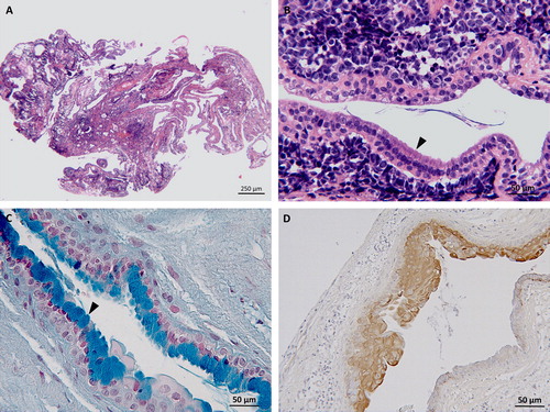 Figure 3. Case 1: (A) histology depicts a cystic and multiloculated, moderately cellular epithelial cell proliferation embedded in moderate amount of stroma, hematoxylin, and eosin stain (2.5×). (B) Higher magnification of (A) columnar epithelium lining an empty cavity and presenting with cilia (arrow head) consistent with respiratory epithelium, hematoxylin, and eosin stain (20×). Case 2: (C) Thin-layered epithelium within the neuroenteric cyst featuring multiple goblet cells containing acidic mucin (arrow head), Alcian blue stain (20×). (D) Immunohistochemistry for pancytokeratin showing a strongly immunoreactive pseudostratified to stratified cuboidal epithelium, DAB as chromogen (20×).