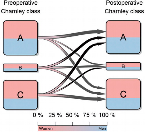 Figure 3. The crossover between Charnley classes from before to after surgery. The patients before surgery are represented on the left while those after surgery are represented on the right. Pink corresponds to the proportion of women in each group while blue corresponds to the proportion of men. The size of the arrow is proportional to the percentage of patients leaving that specific class and the color of the gradient corresponds to the sex proportion for each transition according to the color bar.