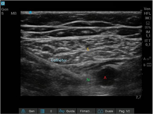 Figure 3 Continuous Adductor Canal Block (cACB): catheter tip posterior position. A 20 Gauge catheter was inserted through the split cannula posteriorly to the saphenous nerve. Sartorius muscle (S); saphenous nerve (N); femoral artery (A).