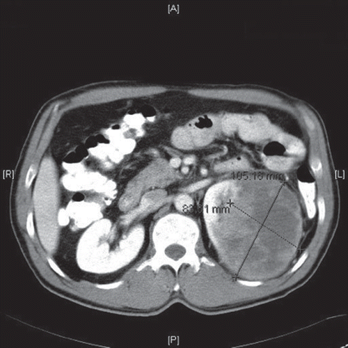 Figure 1. CT scan showing left renal mass.