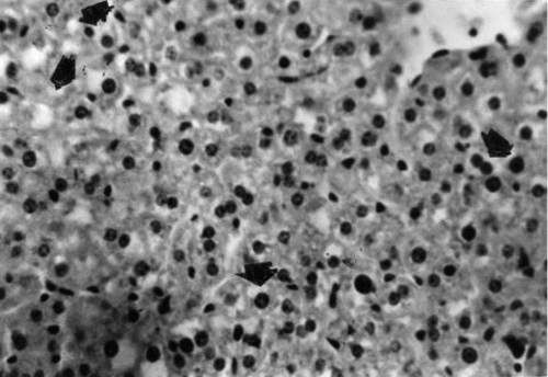 Figure 6 Liver section of mouse in group 3 (1.0 g/kg feed) collected after 63 days of treatment showing widespread vacuolation of hepatocytes and pyknosis of nuclei (arrowhead). H&E stain, ×400.