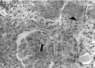 Figure 1. Fibrin thrombus within a glomerulus and fibrinoid necrosis of arterioles. (H&E, × 540).