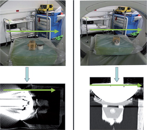 Figure 1. Shoulder prosthesis mounted in 2 different positions in a CT scanner. Humeral component placed against an all-polyethylene glenoid component and the prosthesis aligned perpendicularly (left part of figure) and axially (right part of figure) relative to the axis of the scanner. The opening of the CT scanner is shown, and indicates the orientation of the specimen relative to the scanner. The glenoid component was fixed into a box using PMMA bone cement. The bottom part of the figure shows CT scan images of the artificial total shoulder replacement oriented perpendicular to, and parallel to, the 2D CT acquisition plane. The green arrows in the figure indicate the orientation of the scanner, by which the alignment of the implant with respect to the CT acquisition plane can be evaluated.