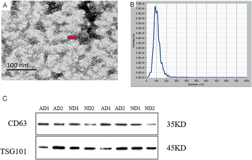Figure 1 Exosome Identification (A). The identification of serum exosomes by transmission electron microscope.The exosome appear as round structures enclosed by double-leaflet membranes, with a diameter of approximately 30–150nm (B). The identification of serum exosomes by Nanoparticle Tracking Analysis.The particle size of exosome is 96.5±33.1nm, with an original concentration of 2.0 × 1011Particles/mL (C). The identification of exosomes specific proteins by Western blot.CD63 is a transmembrane protein with a molecular weight of around 35kDa. TSG101 belongs to the ESCRT related protein with a molecular weight of around 45kDa.