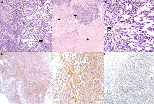 Figure 2. Histological analysis of the primary adamantinoma tumor. (A) Cellular and myxoid areas of the tumor. Scattered thick-walled blood vessels were noted (arrow). Hematoxylin and eosin; original magnification, ×200. (B) Hyalinized (asterisks) and cellular (arrow) areas of the tumor. Hematoxylin and eosin; original magnification, ×100. (C) Nuclear features of the tumor. Occasional mitotic figures (thin arrow) and focal necrosis (thick arrow) were noted. Hematoxylin and eosin; original magnification, ×400. (D) Focal positive immunostaining of the tumor for CD117 (c-kit). CD117 immunostain; original magnification, ×200. (E) Focal positive immunostaining of the tumor for platelet-derived growth factor receptor beta (PDGFR-beta). PDGFR-beta immunostain; original magnification, ×400. (F) Focal positive immunostaining of the tumor for vascular endothelial growth factor receptor-2 (VEGFR-2). VEGFR-2 immunostain; original magnification, ×200.