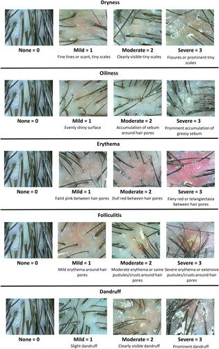 Figure 2. The photographic scale for the Scalp Photographic Index. Dryness is determined by fine lines, scales, and fissures of the surface; mild = 1 (fine lines or scant, tiny scales), moderate = 2 (clearly visible tiny scales), and severe = 3 (fissures or prominent tiny scales). Oiliness is determined by sebum accumulation and shine of the surface; mild = 1 (evenly shiny surface), moderate = 2 (accumulation of sebum around hair pores), and severe = 3 (prominent accumulation of greasy sebum). Erythema is determined by erythema and telangiectasia between the hair pores; mild = 1 (faint pink between hair pores), moderate = 2 (dull red between hair pores), and severe = 3 (fiery red or telangiectasia between hair pores). Folliculitis is determined by erythema and pustules of hair pores; mild = 1 (mild erythema around hair pores), moderate = 2 (moderate erythema or some pustules/crusts around hair pores), and severe = 3 (severe erythema or extensive pustules/crusts around hair pores). Dandruff is determined by coarse and large scales of the surface; mild = 1 (slight dandruff), moderate = 2 (clearly visible dandruff), and severe = 3 (prominent dandruff).
