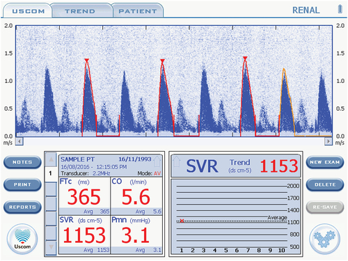 Figure 1. USCOM graphic user interface of the velocity-time signal of a patient’s blood exiting the aortic valve, with superimposed FlowTrace (in red).