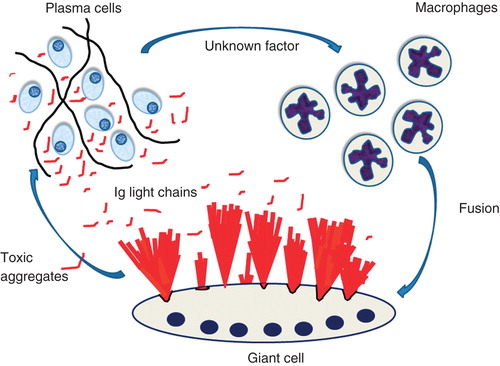 Figure 5. Suggested events in localized AL amyloidosis. A plasma cell clone develops at one site. The cells express amyloidogenic Ig light chains and, in addition, an unknown factor that attracts macrophages and cause them to fuse into giant cells. Ig light chains are modified by giant cells and aggregate into bundles of amyloid fibrils at the surface of these cells. In addition, smaller aggregates of Ig light chains are toxic to plasma cells, an event controlling the plasma cell clone.