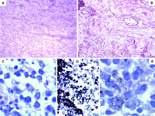 Figure 1.  (A) The testis showed severe tubular atrophy, Leydig cell hyperplasia and absence of germ cells (hematoxylin and eosin×200 magnification). (B) Eosinophilic and mixoid transformation with rare hyalinized tubules (elastic tissue stain×200 magnification). (C) Lymph node core biopsy showed uniform cells with clear cytoplasm and clumped chromatin pattern of nucleus. (D) The neoplastic cells showed strong expression of vimentin. (E) Weak expression of placental alckaline phosphatase.