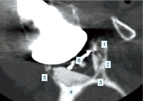 Figure 5. Coronal view of the glenoid bone including the implant. The numbers indicate the 6 zones used in the Molé Score to assess the level of radiolucent lines in the fixation of the glenoid component. Each zone is scored between 0 and 3 points according to the level of radiolucent lines observed and the Molé Score is the sum of these scores.Zone 1: fixation area of the superior part of the glenoid component base plate;Zone 2: fixation area of the superior part of the keel;Zone 3: fixation area of the tip of the keel;Zone 4: fixation area of the inferior part of the keel;Zone 5: fixation area of the inferior part of the glenoid component base plate;Zone 6: fixation area of the central part of the glenoid component base plate.