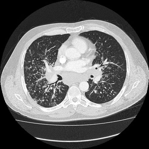 Figure 7. Chest computerized tomography scan displaying lung micronodules/opacities in a distribution typical for pulmonary sarcoidosis along the bronchovascular bundle and in subpleural locations.