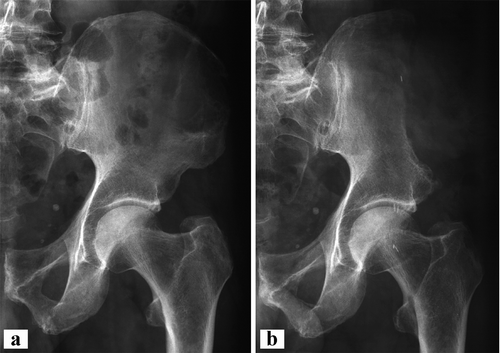 Figure 4. Case 7. a. Giant cell tumor of the left iliac wing. b. After wide resection of the left iliac wing without reconstruction.