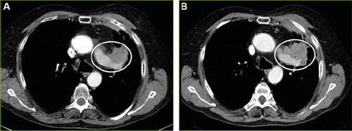 Figure 3. (A) Lung carcinoma in a 66-year-old man. Transaxial section CT scan from January 7, 2009 shows a primary tumor in the left upper lobe (circle) without any known metastasis. (B) A CT scan at the end of the study, September 23, 2009, demonstrates stable disease without any additional changes compared to previous CT scan.