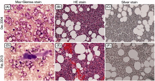 Figure 1. Bone marrow aspirate from the acquired amegakaryocytic thrombocytopenic purpura patient at the time of diagnosis (December 2004) and during treatment with romiplostim (February 2013). (A, D): Smear, May-Giemsa stain, ×400; (B, E): Clot section, HE stain, ×100; (C, F): Clot section, Silver stain, ×100.