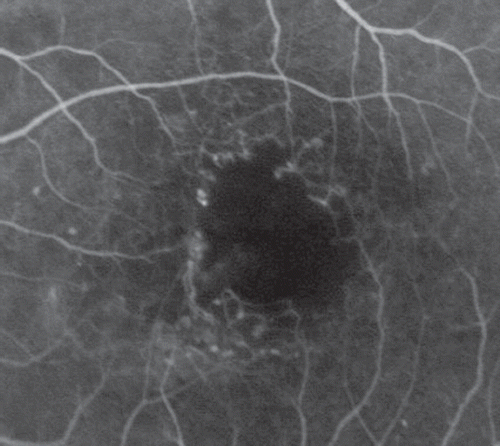 Figure 2. Early phase of the fluorescein angiography in the left eye after resuming trastuzumab treatment: new areas of perifoveal capillary drop-out were observed.