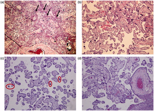 Figure 3. Histopathological examination of the placenta from the current pregnancy reveals fibrinoid deposition (arrow) in the intervillous space, involving 20% of the villi (a) and areas with normal intervillous space (b) (H&E, 100×). Small and poorly developed villi (circle) or distal villous hypoplasia (H&E, 100×) are shown in (c). (d) Displays well-developed villi at 34 weeks of gestation (H&E, 100×).