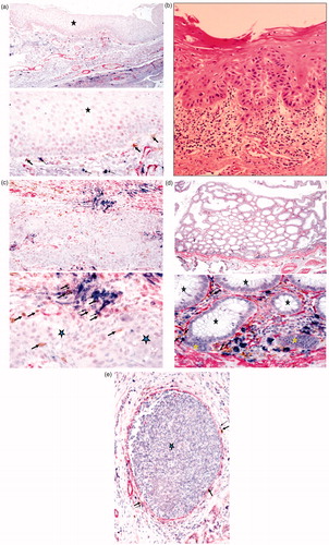 Figure 1. Immunohistochemical analysis of oral, colon, and breast tumor tissues. (a) Healthy inflammatory oral tissue was stained with antibodies to CD16 (Brown), mast cells (Blue), and Smooth Muscle Actin (SMA) (red). Immunohistochemical analysis indicated that NK cells (thick arrows) and mast cells (thin arrows) are located below the normal oral epithelium (star), immediately below the basal layer where stem cells and undifferentiated epithelial cells reside. Please note that the epithelial layer is devoid of infiltrating immune cells. (b) Slides from OSCC were prepared and stained with H&E. Infiltration of immune effectors right beneath the epithelial layer can be seen in a connective tissue area where immune inflammatory cells are likely to condition NK cells to lose cytotoxicity and to support differentiation of epithelial cells. (c) Oral tumor tissue stained with the antibodies against CD16, mast cells, and SMA, as indicated above. Immunohistochemical analysis indicated that NK cells (thick arrows) and mast cells (thin arrows) are located along oral tumor capsules, with only a few infiltrating immune cells seen within the epithelium (star). (d) Colorectal tumor tissue stained as above. Immunohistochemical analysis indicated that NK cells (thick arrows) and mast cells (thin arrows) were located along colorectal epithelial capsules, with only a few infiltrating immune cells seen within the normal (black stars) and tumor (yellow star) epithelium. (e) Breast tumor tissue stained as described above. Immunohistochemical analysis indicated that NK cells (thick arrows) and mast cells (thin arrows) were located along breast tumor capsules, with only a few infiltrating immune cells seen within the epithelium (star).