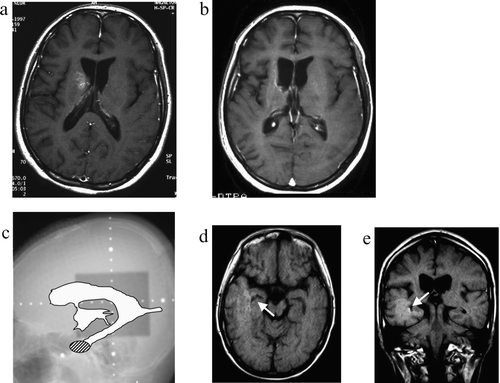 Figure 3.  Case 3, a 16-year-old boy. a: Pre-treatment MRI scan revealing an enhanced lesion in the right basal ganglia. b: Post-treatment MRI scan shows complete disappearance of the lesion. c: On this x-radiograph, the field of irradiation (gray area) and the ventricles (white area) on MRI scans are traced. The relapse site is identified by a hatched circle. d: This post-treatment MRI scan (axial view) reveals an enhanced lesion in the inferior horn of the right lateral ventricle (arrow). e: MRI scan obtained at the time of tumor recurrence (coronal view).